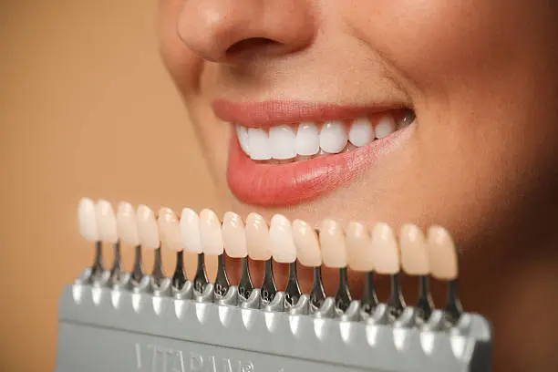 Sorriso perfetto con trattamenti di estetica dentale — Odontomedica San Matteo